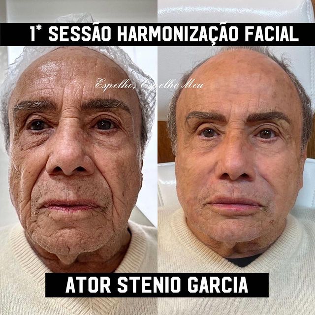 Stênio Garcia faz harmonização facial. Foto: Reprodução/Instagram/@espelhoespelhomeutatui Lorena Bueri