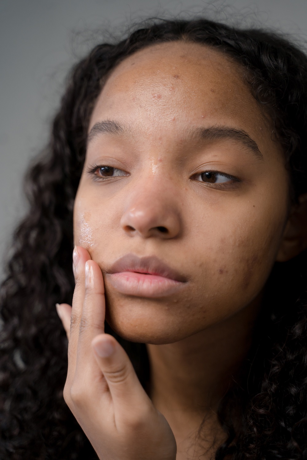 Muitas mulheres sofrem com acne na idade adulta por causa do estresse. (Foto: Pexels)