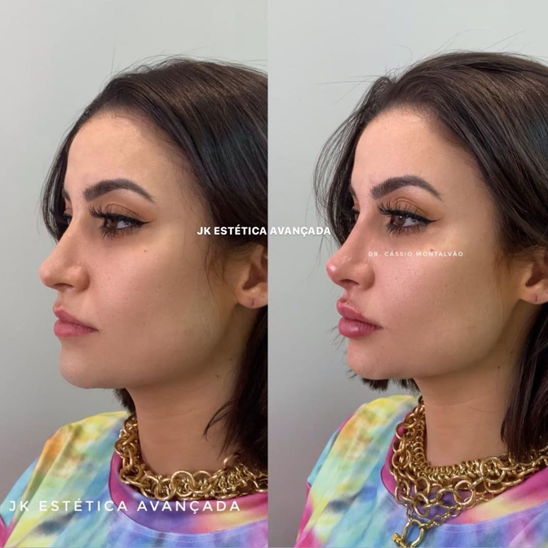 Resultado da harmonização facial em Bianca Andrade. (Foto: Reprodução/Instagram)