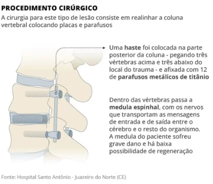 Infográfico mostra como é feita a cirurgia em homem que teve a coluna lesionada por aparelho 