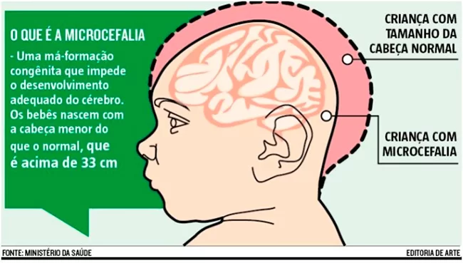 Demonstração e explicação do que é a microcefalia. 