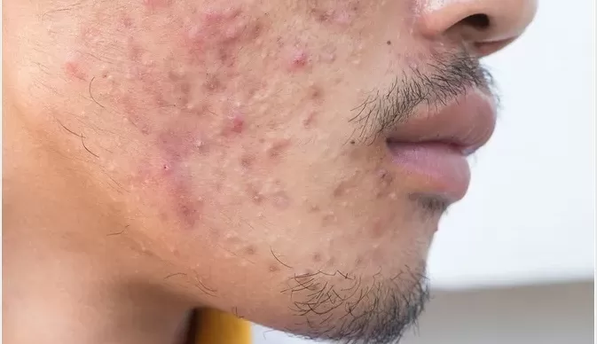4 dicas para evitar a acne masculina devido ao uso de máscaras no verão