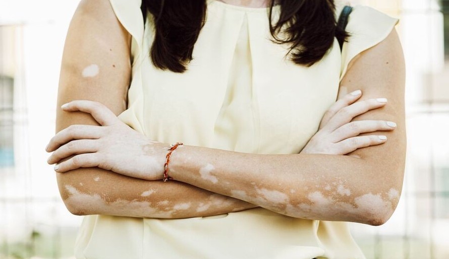 Vitiligo: como cuidar da pele no verão Lorena Bueri