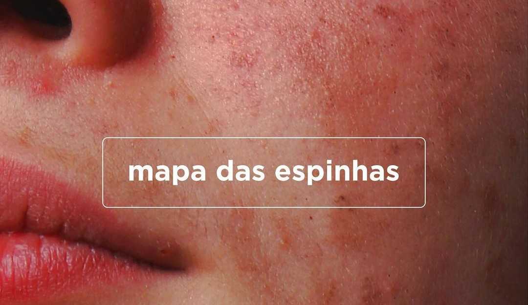 Mapa das espinhas: o significado da acne em cada região do rosto 