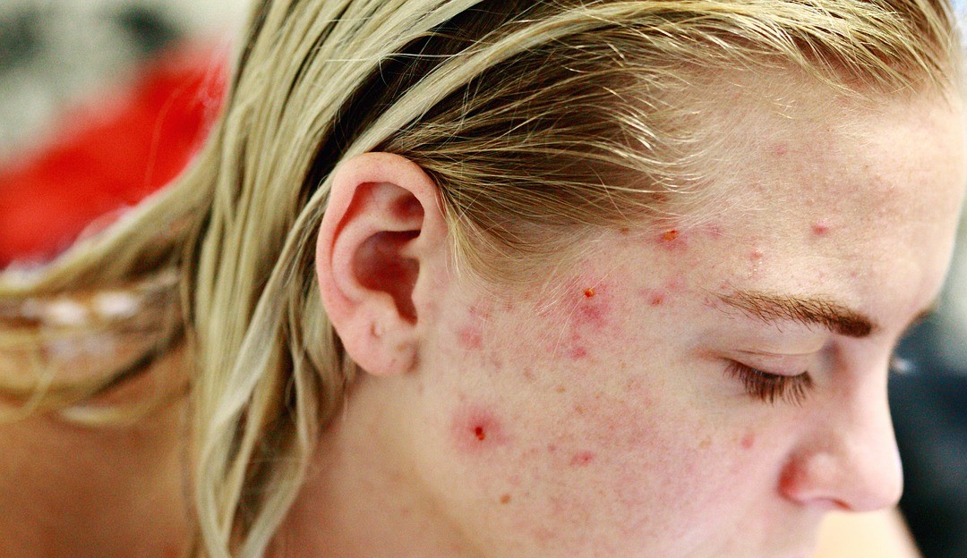 Dicas para evitar o aparecimento das acnes Lorena Bueri
