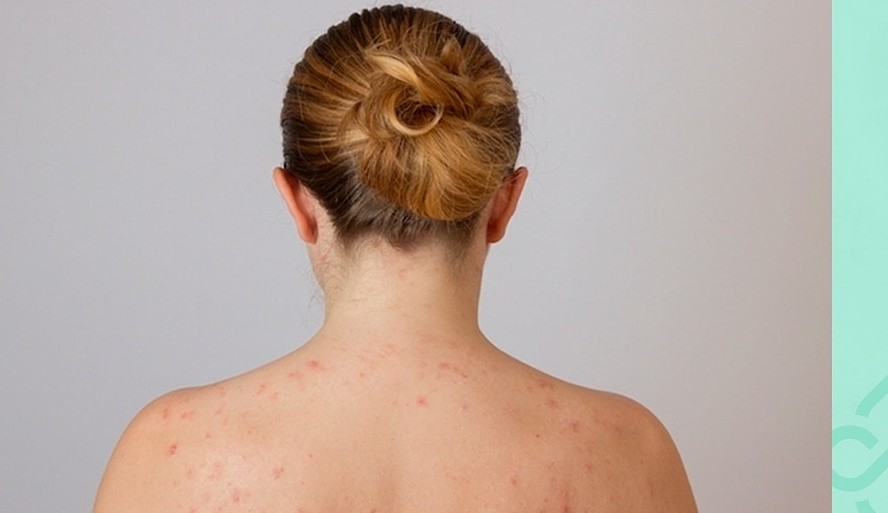 Descubra como evitar o aparecimento de acne nas costas Lorena Bueri