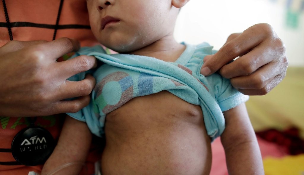 OMS e UNICEF apontam crescimento nos casos de sarampo em todo o mundo