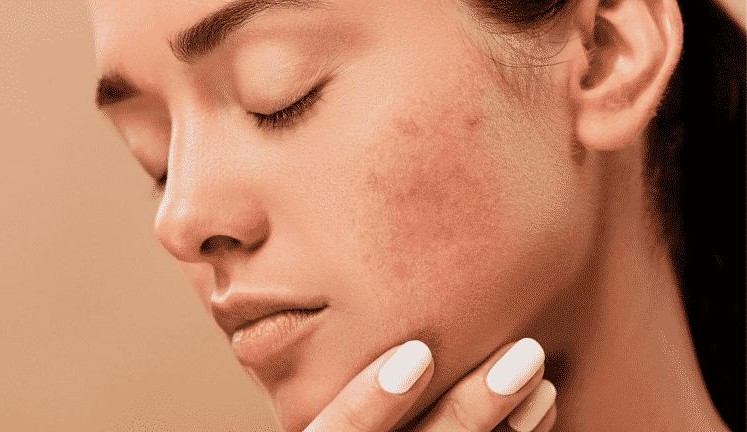  5 formas de melhorar a textura da pele e deixá-la mais lisa