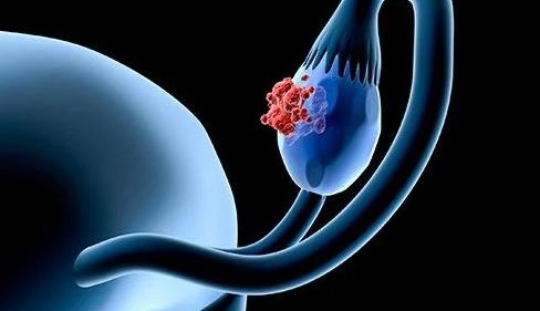Entenda as dificuldades de diagnóstico do câncer de ovário
