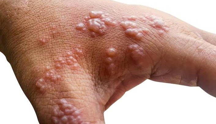 Inglaterra confirma dois novos casos de varíola dos macacos Lorena Bueri