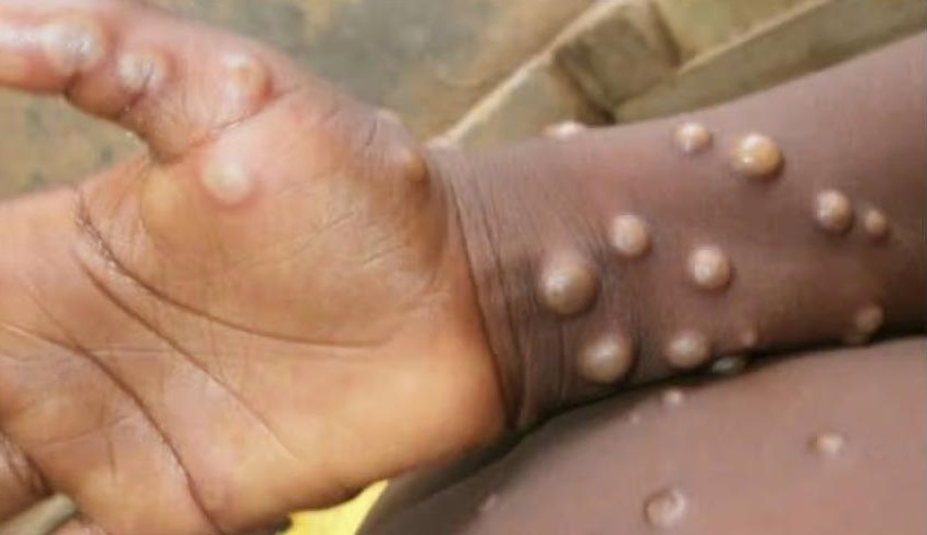 Diretor da OMS confirma novos casos de varíola dos macacos na Europa Lorena Bueri