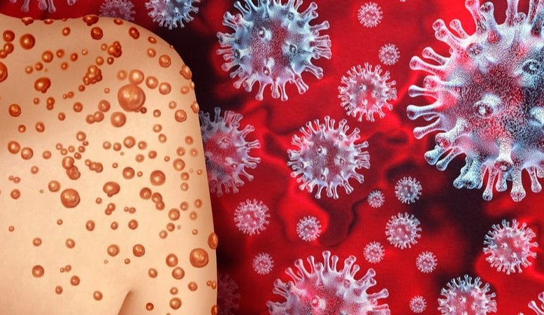 Varíola dos macacos: conheça as diferenças entre a ‘monkeypox’ e a COVID-19