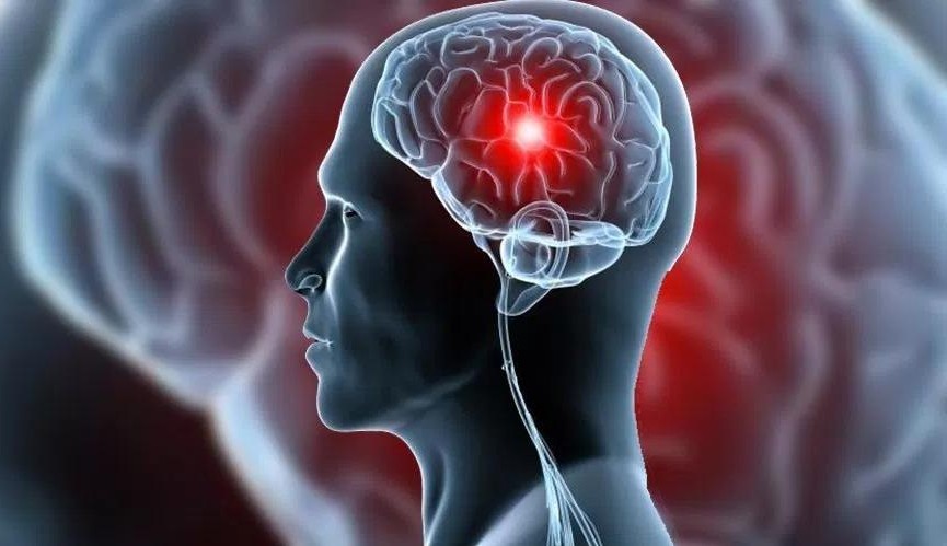 Acidente vascular cerebral: saiba como reconhecer os sinais iniciais do AVC