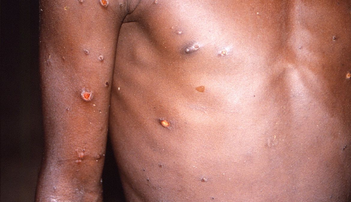 Brasil confirma transmissão comunitária da varíola dos macacos no país