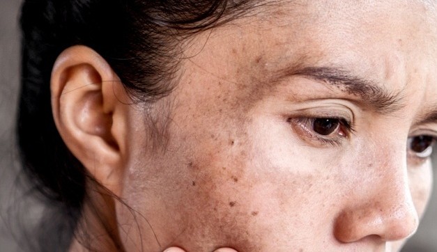 Manchas na pele: descubra como indentificar e tratar cada uma delas Lorena Bueri