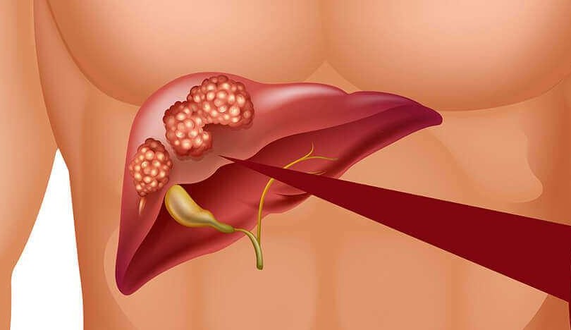Câncer de fígado: conheça causas, fatores de risco, sintomas e tratamentos comuns