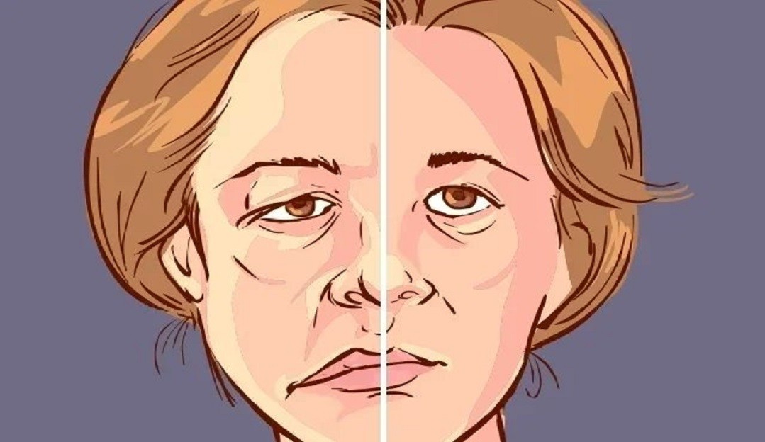 Paralisia de Bell: Saiba mais sobre a doença que afeta o rosto