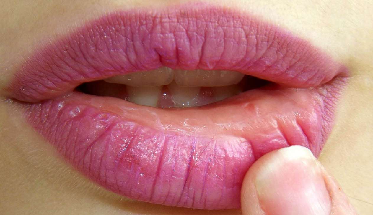 Veja como evitar ressecamento, rachaduras e fissuras nos lábios Lorena Bueri