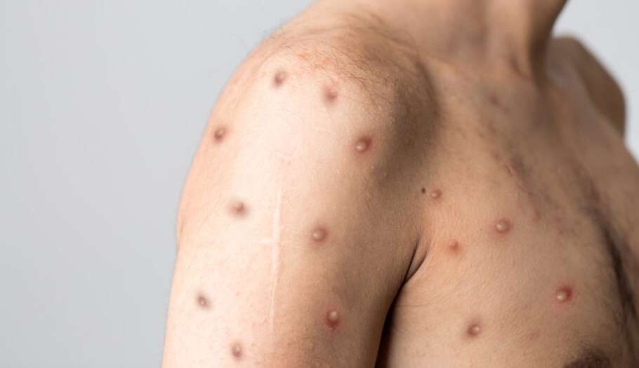 Evidências do vírus da monkeypox são encontradas em superfícies domésticas