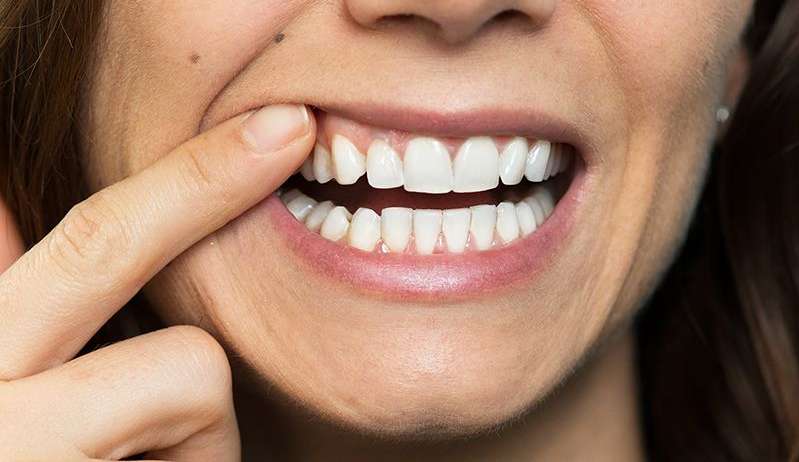Conheça as vantagens dos implantes dentários Lorena Bueri