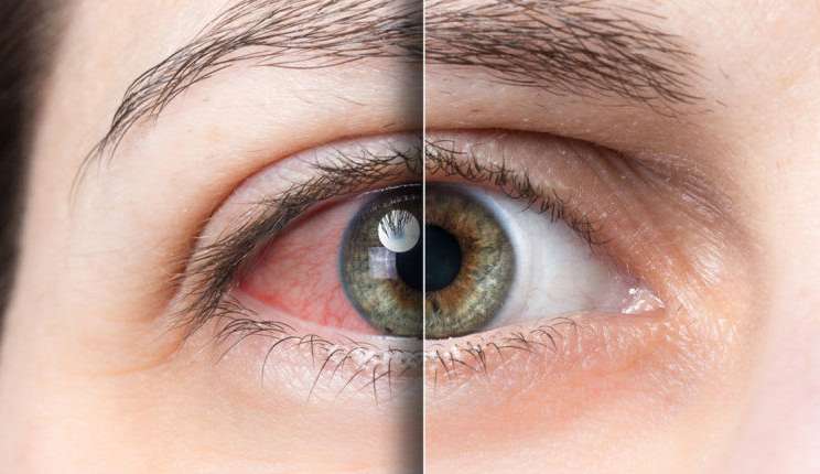 Síndrome do olho seco: médico detalha cuidados que aliviam os incômodos