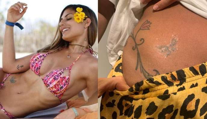Ex-BBB Mari Gonzales recorre à processo de remoção de tatuagem Lorena Bueri