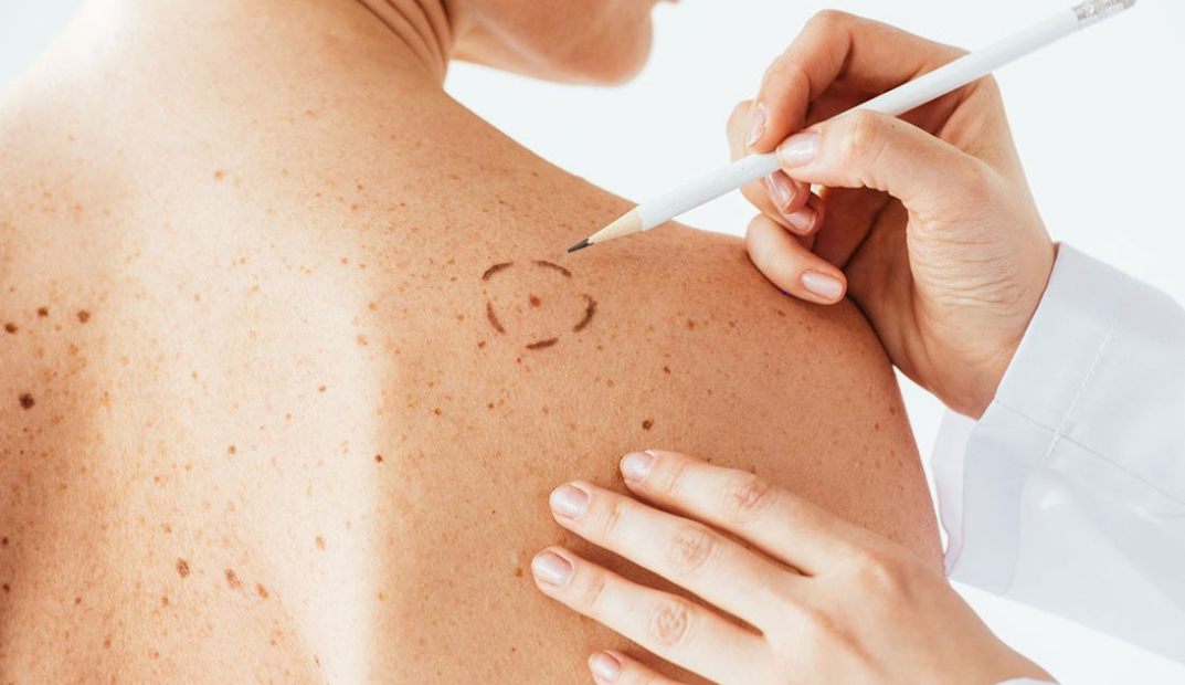 Dermatologista ensina quais são os sinais de alerta e sintomas do Câncer de Pele