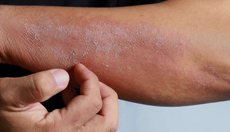 Sintomas e tratamento para dermatite atópica 