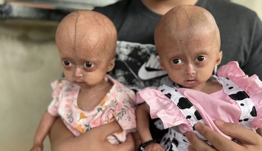 Irmãs gêmeas são identificadas com síndrome rara de velhice precoce em Roraima Lorena Bueri