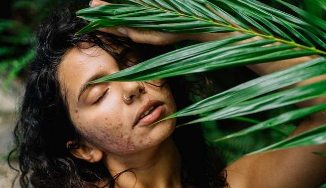O uso de Roacutan para pele acneica deve ser evitado