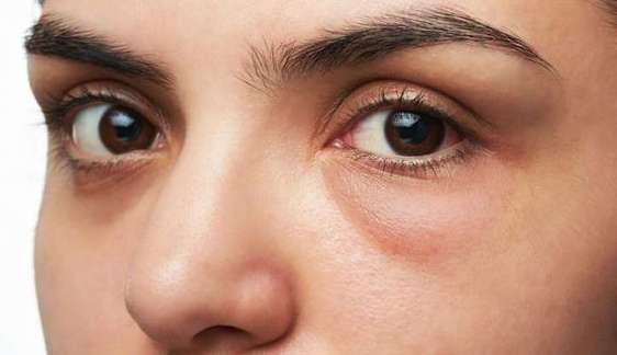 Conheça produtos naturais que ajudam no tratamento de olheiras Lorena Bueri