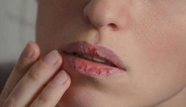 Xerostomia de inverno: descubra quando se preocupar com a boca seca durante a estação Lorena Bueri