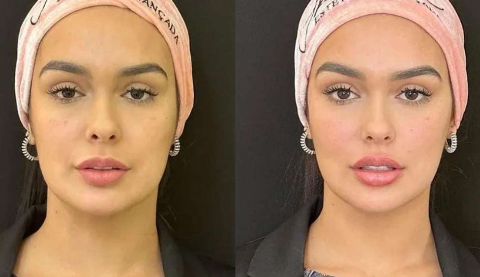 Modelo e ex-BBB, Larissa Santos, se rende a harmonização facial Lorena Bueri