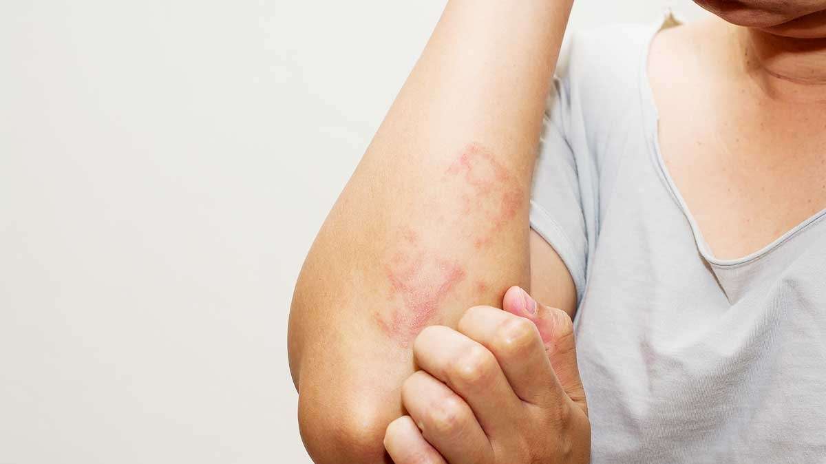 Alergias de pele no Inverno: saiba quais surgem mais no período e como evitá-las!  Lorena Bueri