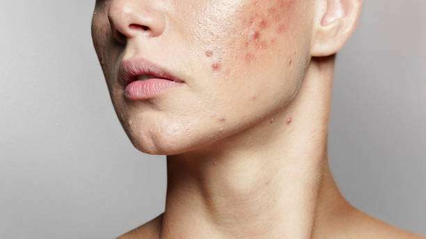 Acne: usar colírio para suavizar espinhas, pode dar alergia e irritação na pele Lorena Bueri