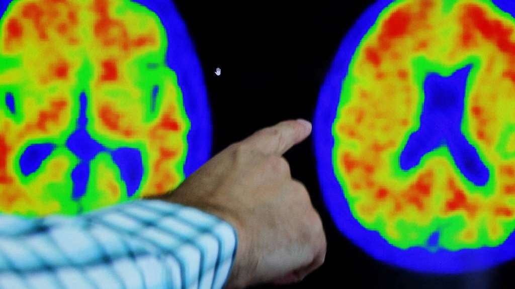 Alzheimer: Nova droga reduz em até 60% a progressão da doença Lorena Bueri