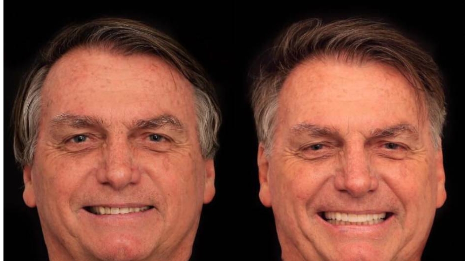 Bolsonaro realiza harmonização facial e gasta 3 mil reais em cada dente Lorena Bueri
