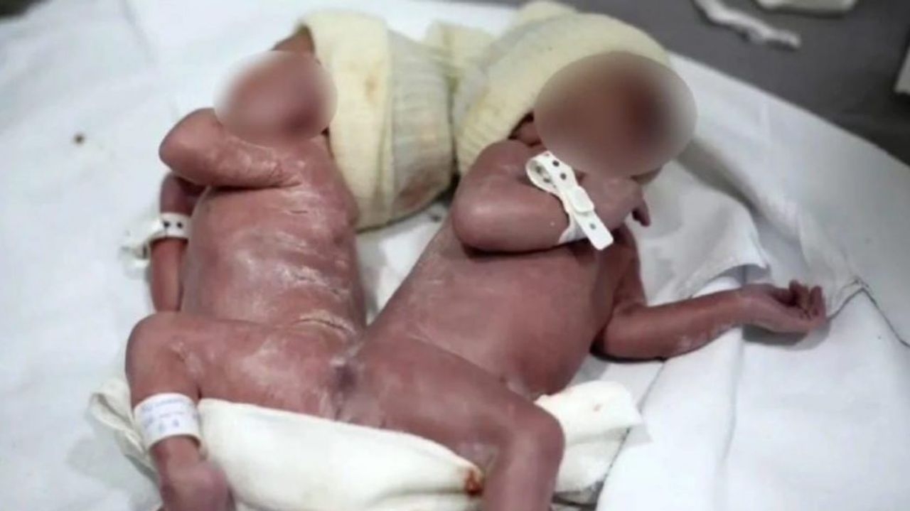 Em caso raro, gêmeos nascem unidos por osso da coluna no Paraná Lorena Bueri