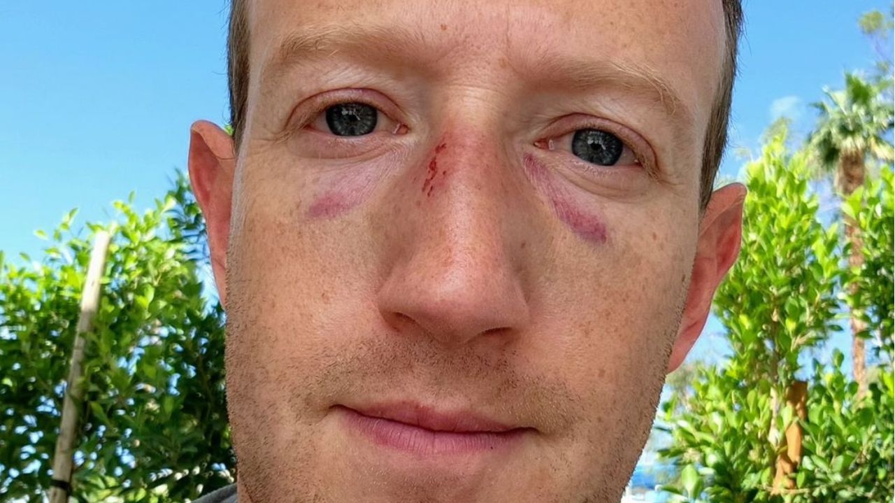 Mark Zuckerberg posta selfie com hematomas no rosto Lorena Bueri