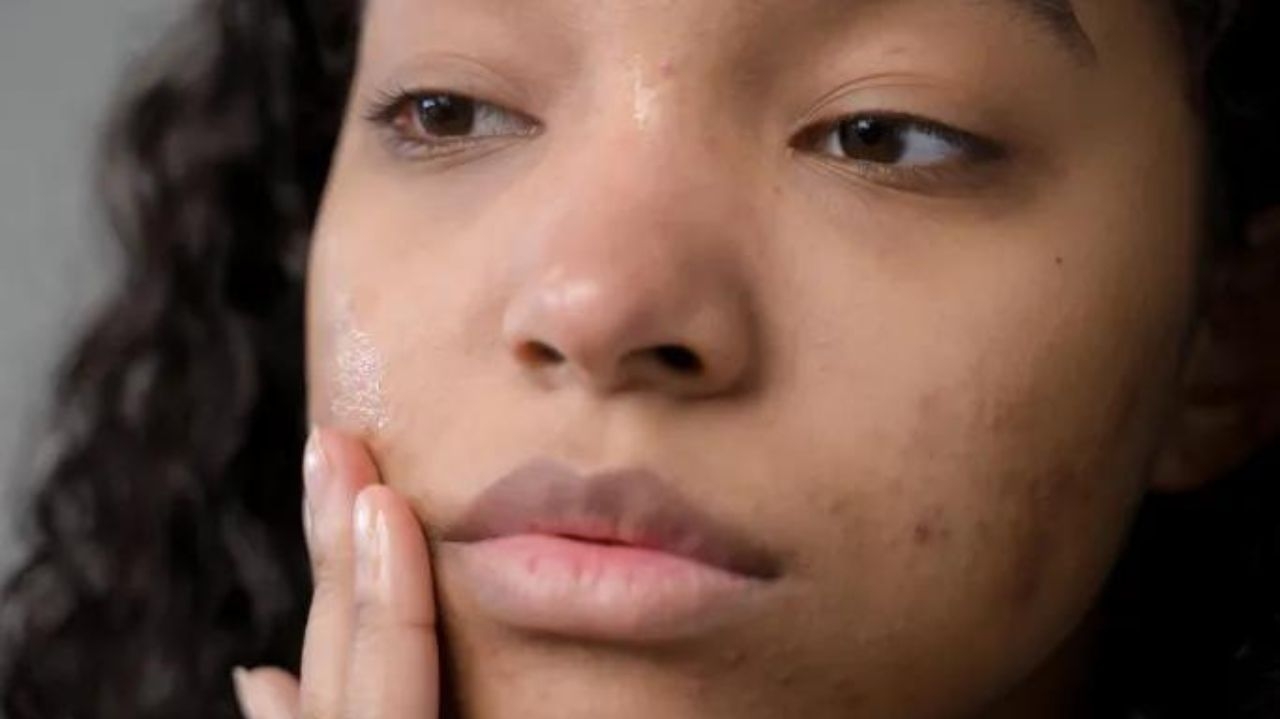 Ácido azelaico pode ser solução efetiva para a acne Lorena Bueri
