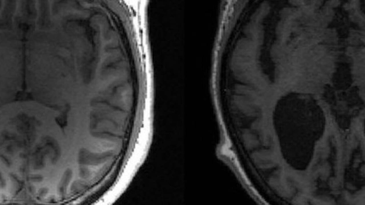 Estudo revela fatores ligados à morte neuronal no Alzheimer Lorena Bueri