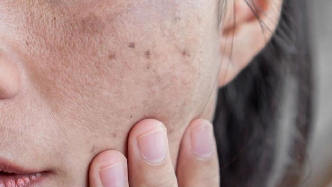 Hiperpigmentação da pele: entenda como ocorre e qual tratamento é mais indicado para a condição Lorena Bueri