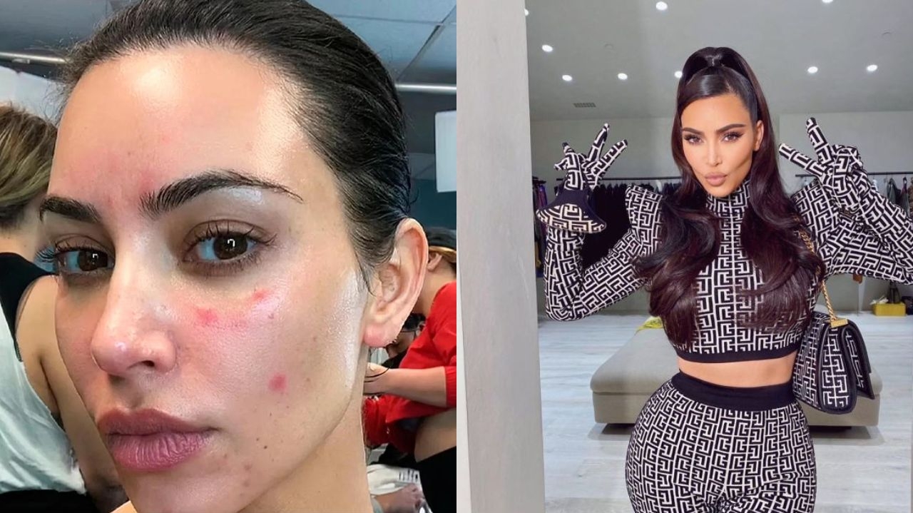 Kim Kardashian lamenta piora em seu quadro de psoríase Lorena Bueri