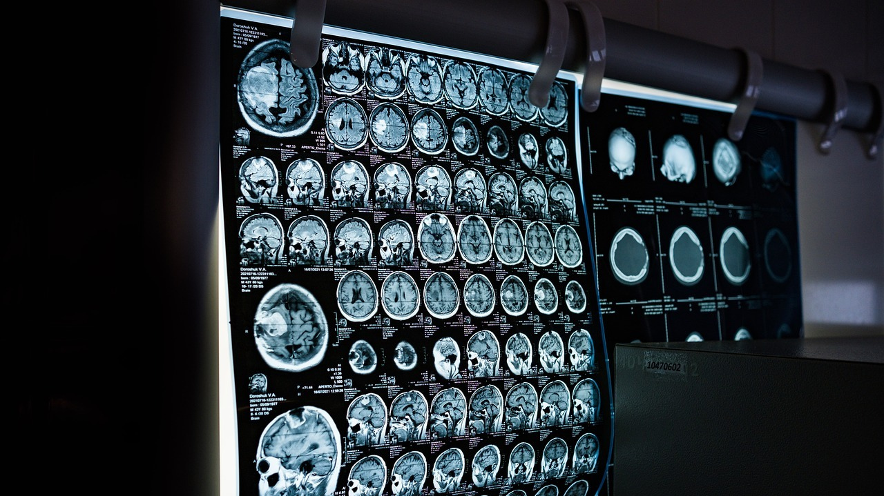 Aumento de tamanho do cérebro reduz risco de demência, diz pesquisa  Lorena Bueri