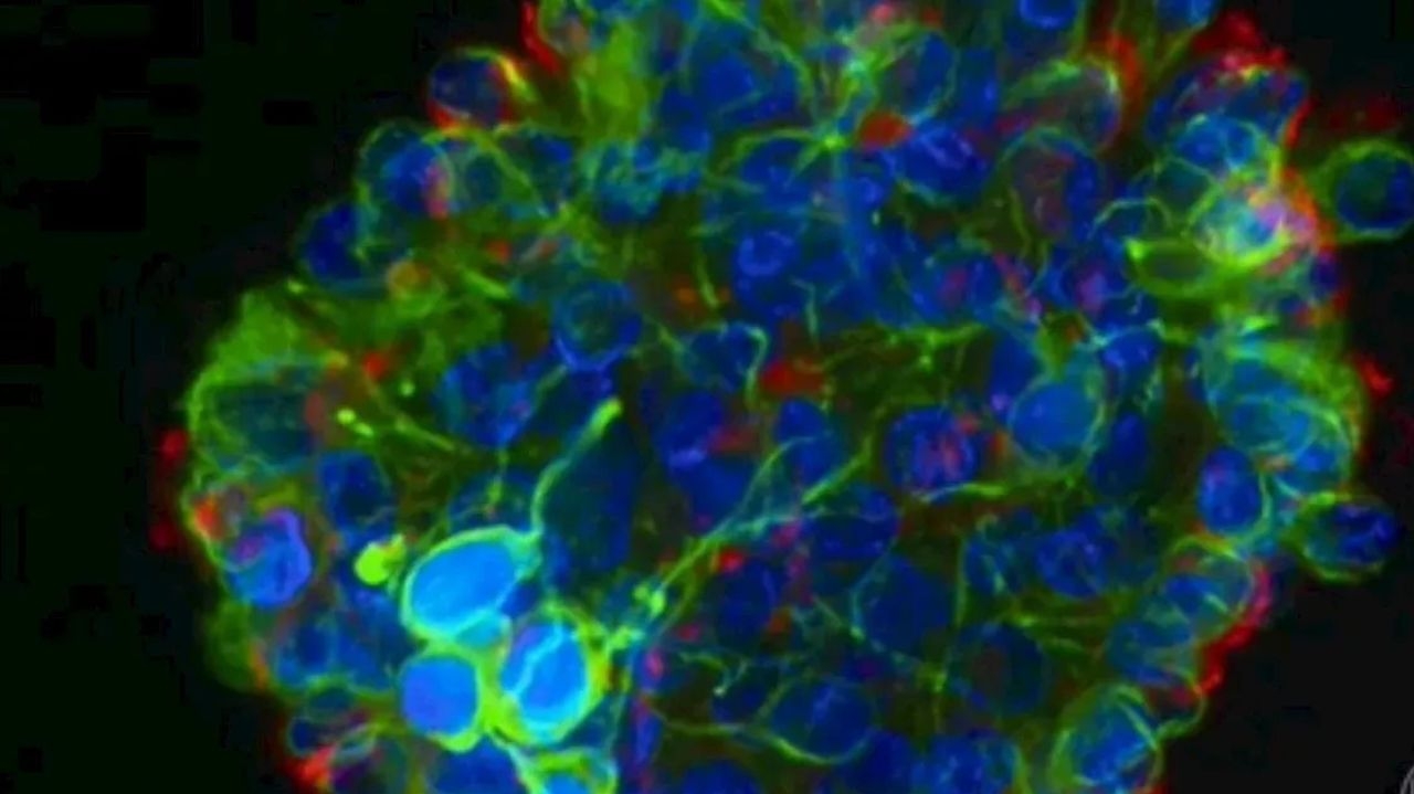 Câncer cerebral: cientistas clonam célula maligna para testar tratamentos  Lorena Bueri