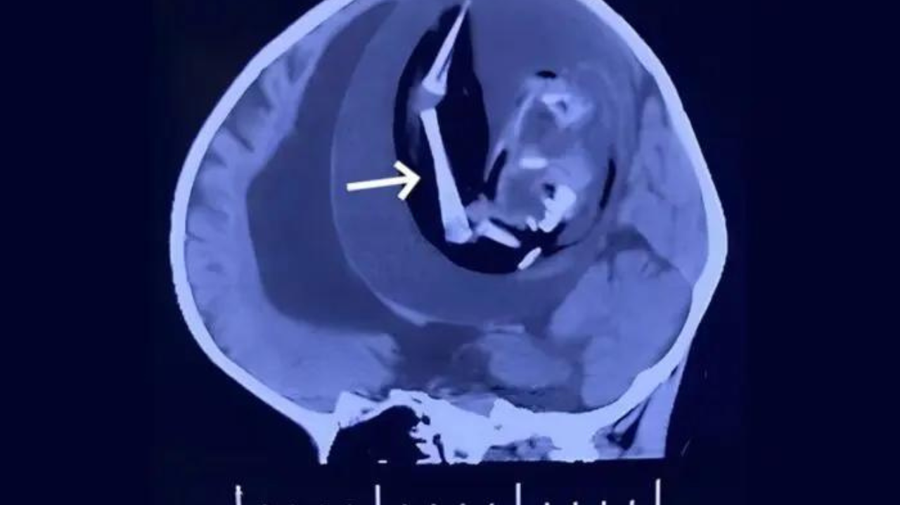 Anomalia rara: médicos encontram feto vivendo no crânio de outro bebê Lorena Bueri