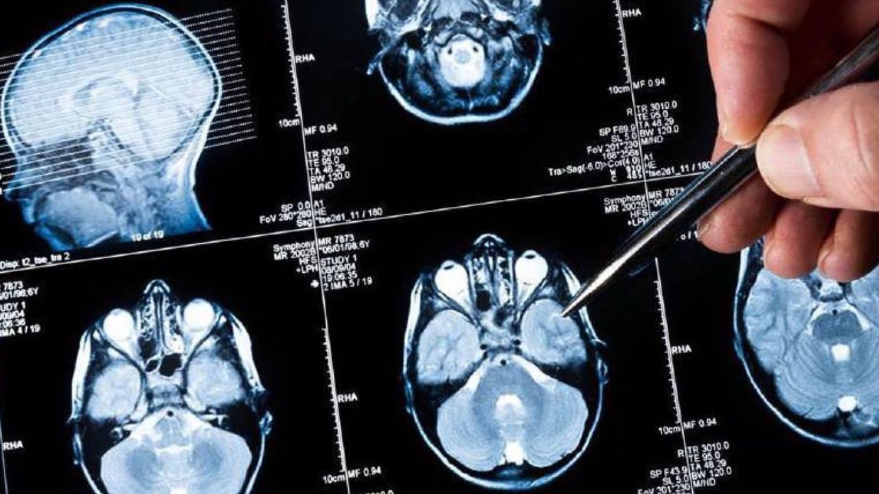 Médicos alertam sobre o risco do câncer cerebral que matou a atriz mirim Millena Brandão  Lorena Bueri