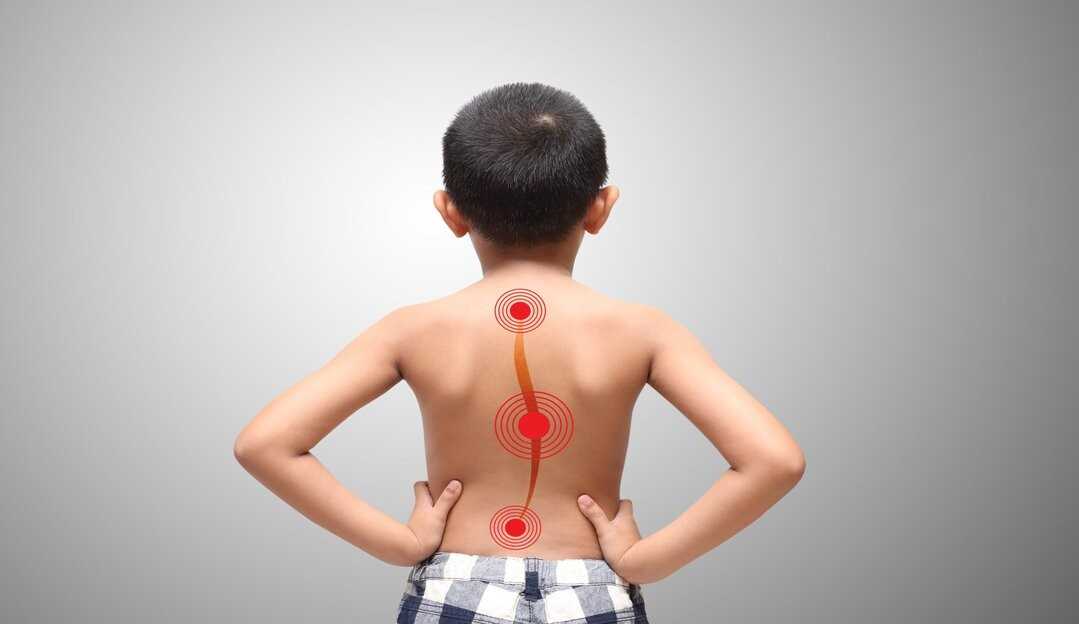Escoliose: o que é, principais sintomas e como tratar