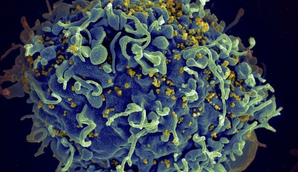 Paciente com HIV é “/curada”/ após transplante de células-tronco