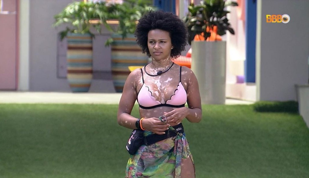 Natália diz que Michael Jackson é sua inspiração para enfrentar o vitiligo